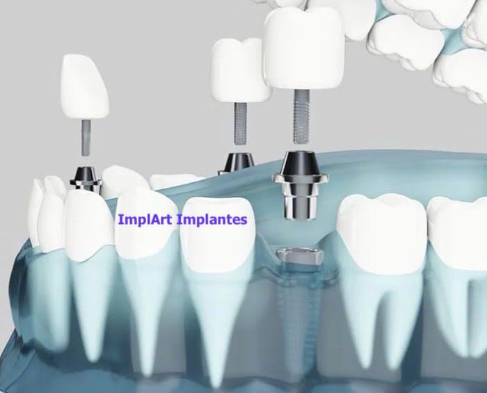 implante de tres dentes separados