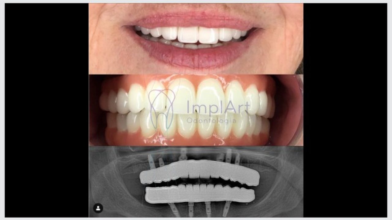 Introduzir 78 imagem modelo de prótese fixa br thptnganamst edu vn