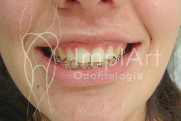 tratamento sorriso gengival antes e depois 50kb Implantes Dentários e