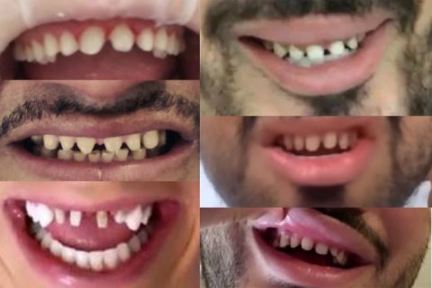 Lentes Dentais Desgaste Em Forma De Dente De Tubar O