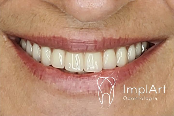 RESINA-SITE Prótese protocolo | Gengiva caracterizada e dentes importados