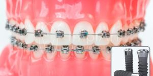 aparelho_ortodontico_implante_50kb Implante dentário: a idade do paciente interfere no sucesso?