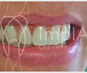 protocolo_branemark_48kb Recuperação de um implante dentário: quanto tempo?