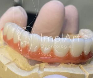protese_total_zirconia_superior_para_implantes_50kb Implante dentário em quem usa aparelho ortodôntico