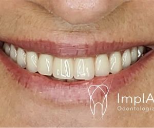 RESINA-SITE Coroa de zircônia pura para implantes