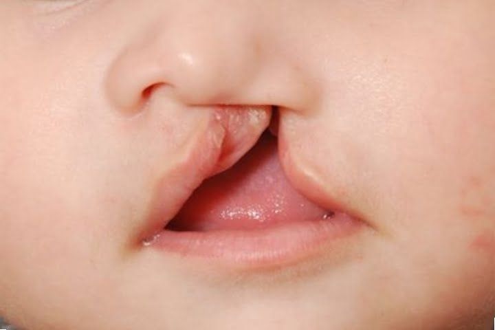 labio-leporino-agenesia-4 Lábio leporino e implantes dentários para substituir dentes