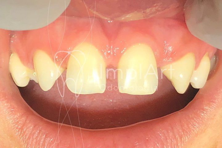 agenesia_50kb Agenesia dentária e a necessidade de implantes