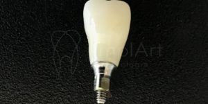 coroa_aparafusada Fotos de tratamentos com estética dental e implantes dentais