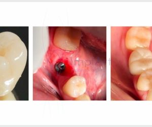 Coroa_de_zirconia_translucida_para_implantes_40kb Novo Implante Straumann iEXCEL: implante rápido com osseointegração em 21 dias