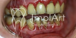 fumaca_de_cigarro_eletronico_efeitos_nos_dentes_50kb Carga imediata com 4 implantes para prótese protocolo