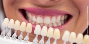 escolher_cor_dos_dentes_escala_50kb Implante dentário renova o sorriso e a vida