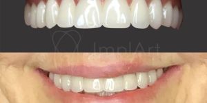 protese_zirconia_porcelana_implante_50kb Irrigador dental é um aliado da boa higiene oral para implantes