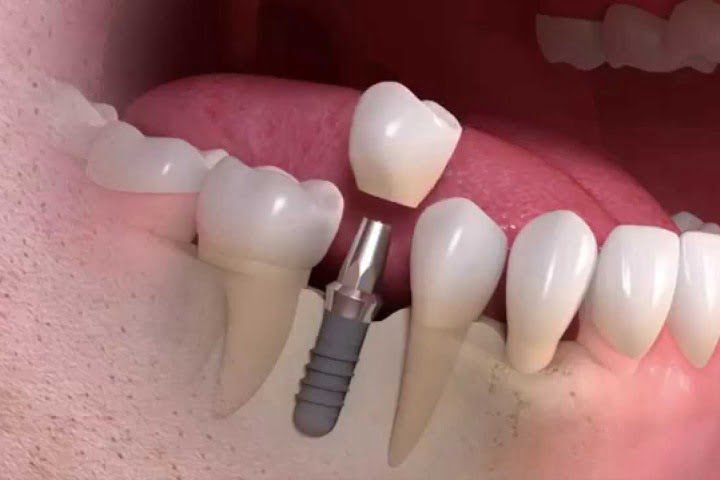 implante_unitario_straumann_50kb Vídeo: cirurgia de implante dentário