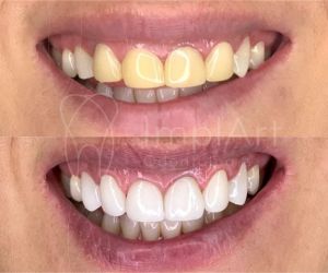 lentes_de_contato_dental_antes_e_depois_47kb Dentista o profissional que cuida do seu sorriso