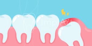 Dente_siso_doendo_50kb Qual material para prótese dentária tem maior durabilidade?