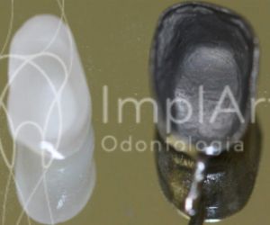 nucleo_estetico_x_metalico_49kb Implante dentário em quem usa aparelho ortodôntico