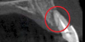 raiz_fraturada_50kb O que fazer quando a prótese dentária machuca?