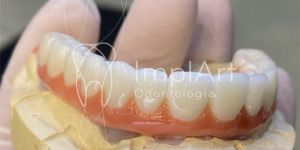 protese_total_zirconia_superior_para_implantes_50kb Coroa de Porcelana Metal Free