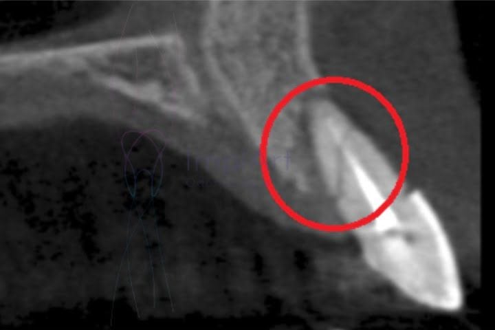 raiz_fraturada_50kb A fratura da raiz e a extração dentária é uma indicação para cirurgia imediata de implante