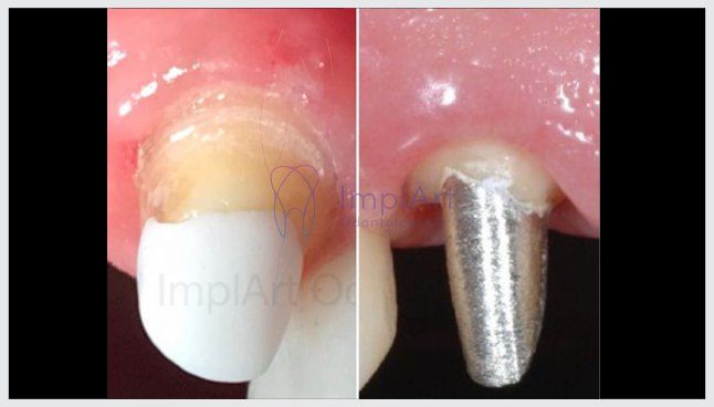 nucleo_estetico_x_nucleo_metalico_30kb Núcleos Estéticos - Realizam um reforço estrutural em raízes dentárias