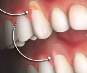 enxerto_de_gengiva_50kb Dentista o profissional que cuida do seu sorriso