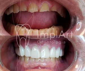 Bruxismo_antes_depois_coroas_ceramicas_1 Epilepsia e a Odontologia: tratamento dental e implante dentário