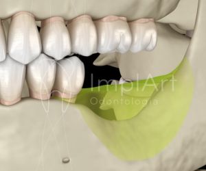 perda_ossea_dentaria_49kb Coroa dentária em um dia para restaurar dentes rápido