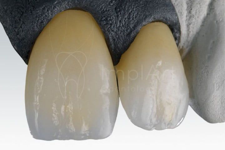 zirconia_cubica_translucida_fx_50kb Coroas de zircônia pura indicadas para pacientes com Bruxismo