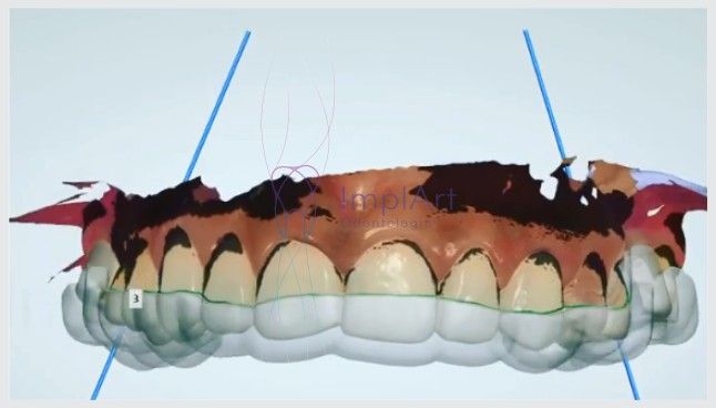 cirurgia_guiada_de_implantes_40kb Cirurgia de implantes dentários guiada por computador