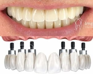 all-on-6 Clínica de Implante Dentário e Prótese Dentária ImplArt