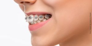 aparelho_ortodontico_convencional_49kb Cirurgia de aumento de coroa clínica: o que é?