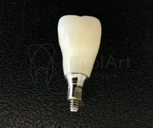 coroa_aparafusada O que é enxerto ósseo dentário