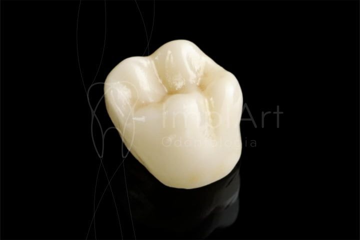 coroa_zirconia_estetica_cerec_50kb Depois de um tratamento de canal deve-se fazer restauração ou núcleo e coroa de porcelana?