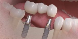 ponte_fixa_sobre_implantes_50kb Enxerto ósseo com plasma rico em fibrina