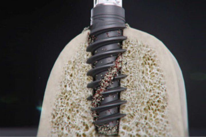 osseointegracao_de_implantes_49kb Implante dentário: passo a passo com fotos