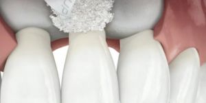 enxerto_osseo_dentario_50kb Gengiva inchada: o que pode ser?