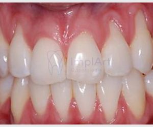 retracao_gengival_25kb Implante de Três Dentes Juntos - Como fazer ?