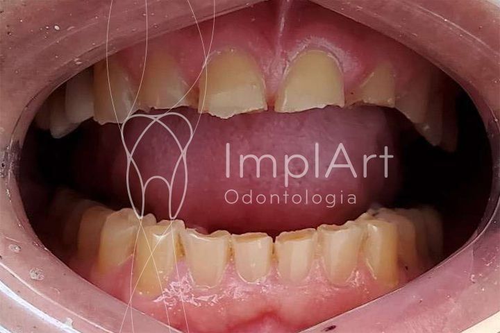bruxismo_dentes_desgastados O bruxismo causa desgaste nos dentes
