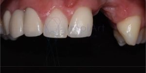 perda_ossea_reabsorcao_50kb Perda óssea dentária o que, como evitar, tem tratamento?