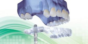 cirurgia_guiada_cirurgia_sem_corte_50kb Retração gengival é reversível?
