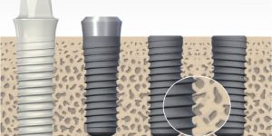 osseointegracao_de_implante_50kb Desvendando os Mitos sobre Implantes em Idosos