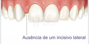 agenesia_dental O que é enxerto ósseo dentário