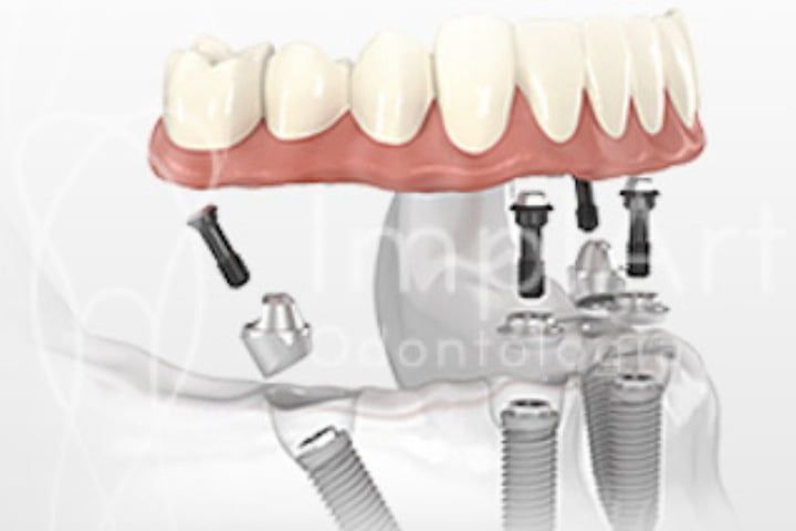 Carga_imediata_All_on_4_50kb Carga imediata com 4 implantes para prótese protocolo
