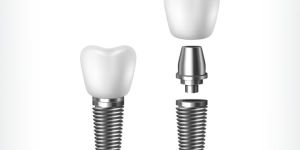 implante_pilar_coroa_50kb-1 Quanto custa um implante com carga imediata