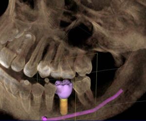 tomografia_radiologia_digital_50kb Quantos implantes dentários são colocados de cada vez?