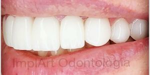 coroas_de_porcelana_lente_de_contato_dental_40kb Rejeição de implante dentário: pode ocorrer?