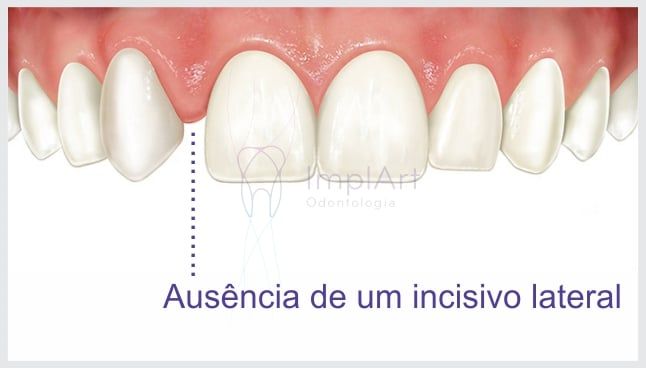 agenesia_dental Agenesia: dentes que não nasceram podem ser supridos com implantes?