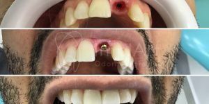 implante_dentario_unitario_50kb O que é enxerto ósseo dentário