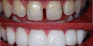 lente_contato_dental_diastema_50kb Implante zigomático: desvantagens e riscos