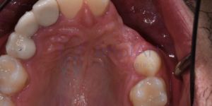 perda_ossea_falta_dentes_50kb Indicações para a prótese dentaria adesiva